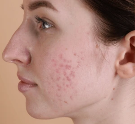 1747368952_acne-treatment-before (2).png